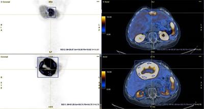 Potential value of pre- and post-therapy [68Ga]Ga-DOTA-TATE PET/CT in the prognosis of response to PRRT in disseminated neuroendocrine tumors